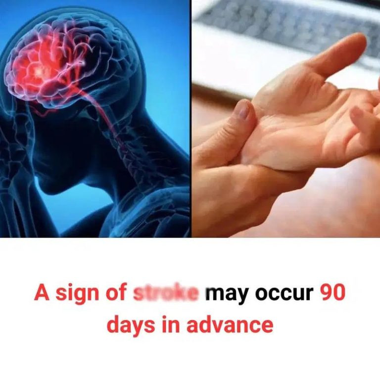 A Sign of S.t.r.o.k.e May Occur 90 Days in Advance