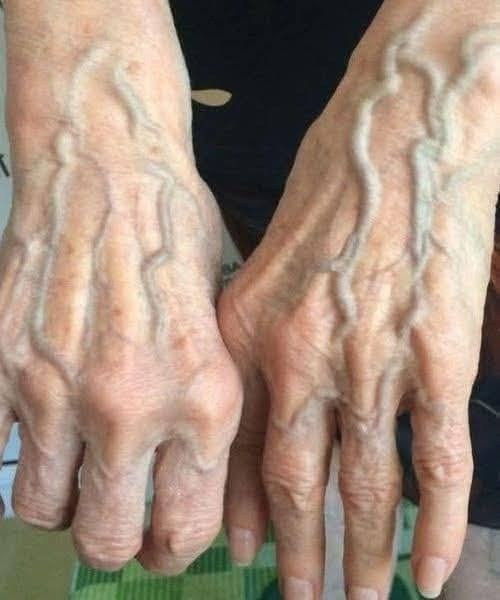 If Your Hand Veins Suddenly Changed – Here’s What It Might Mean