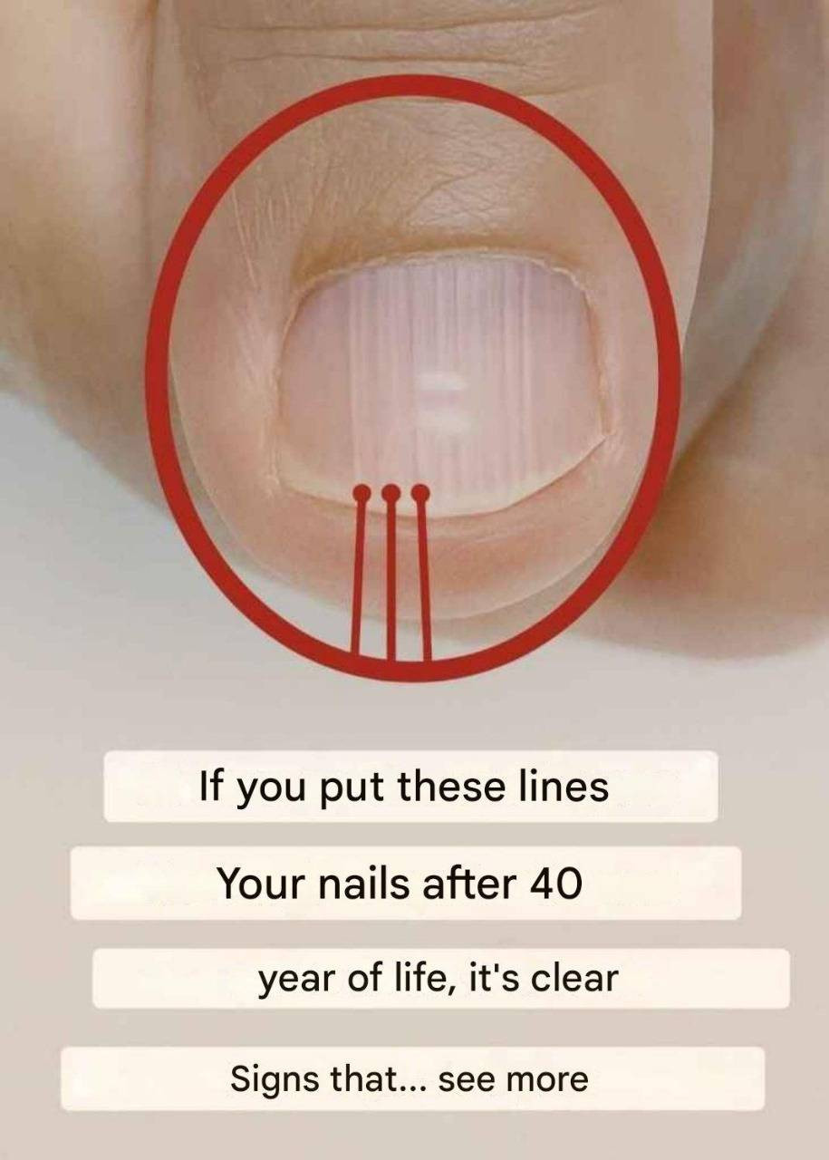 What Those Vertical Lines on Your Nails Really Reveal