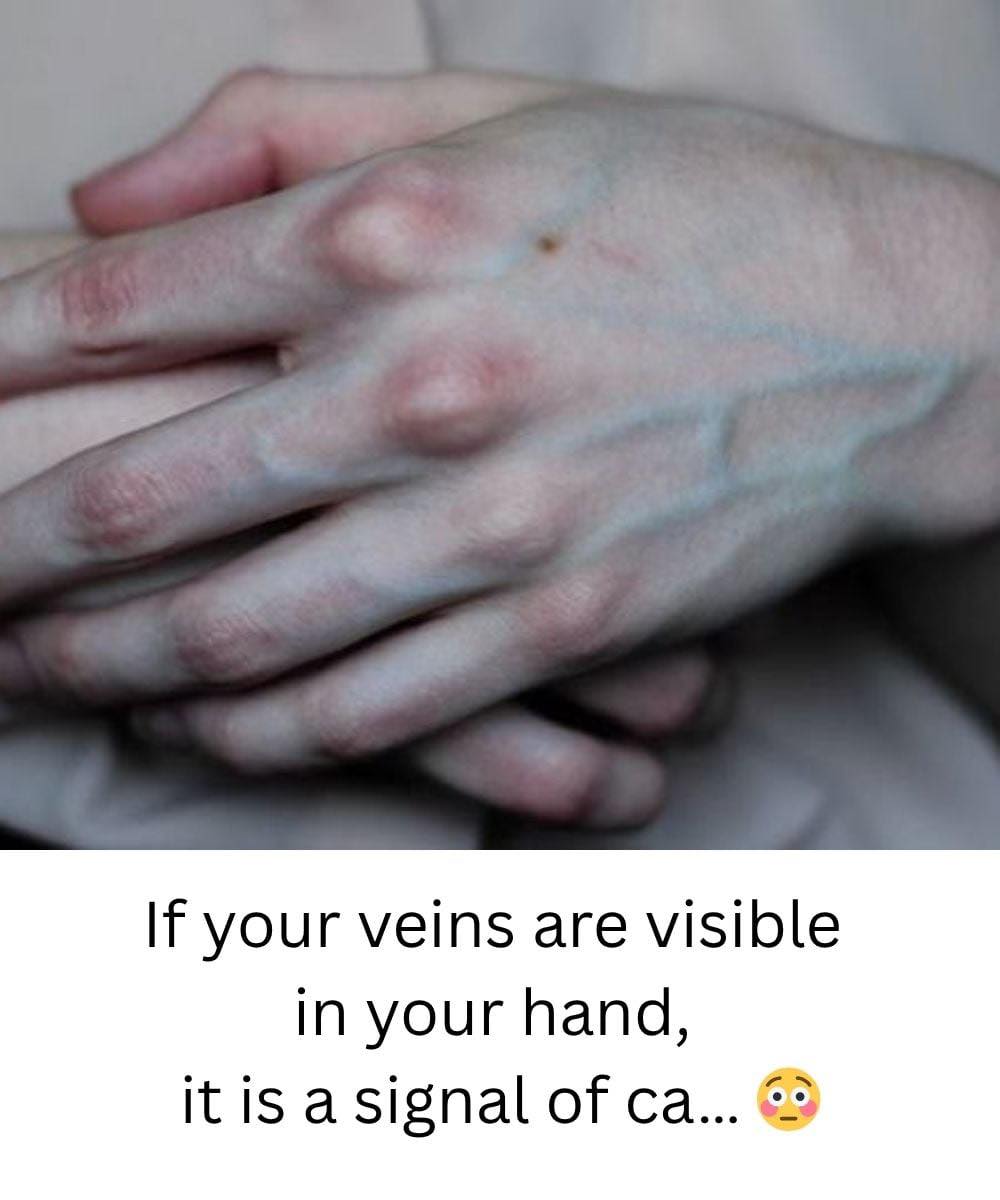 What the Veins on Your Hands Might Reveal About Your Liver Health