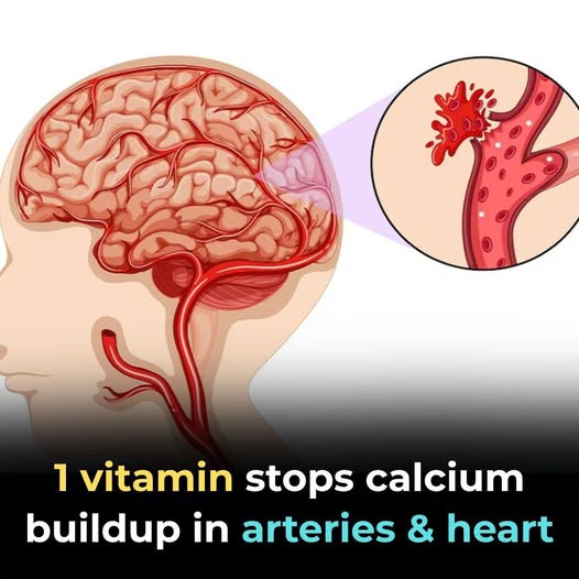 The One Vitamin That Prevents Calcium Buildup in Arteries and the Heart