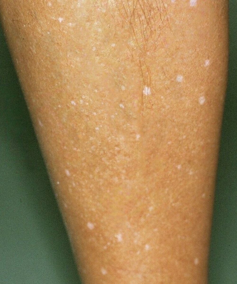 White Spots on Skin! Which Vitamin Deficiencies Could Be the Cause?
