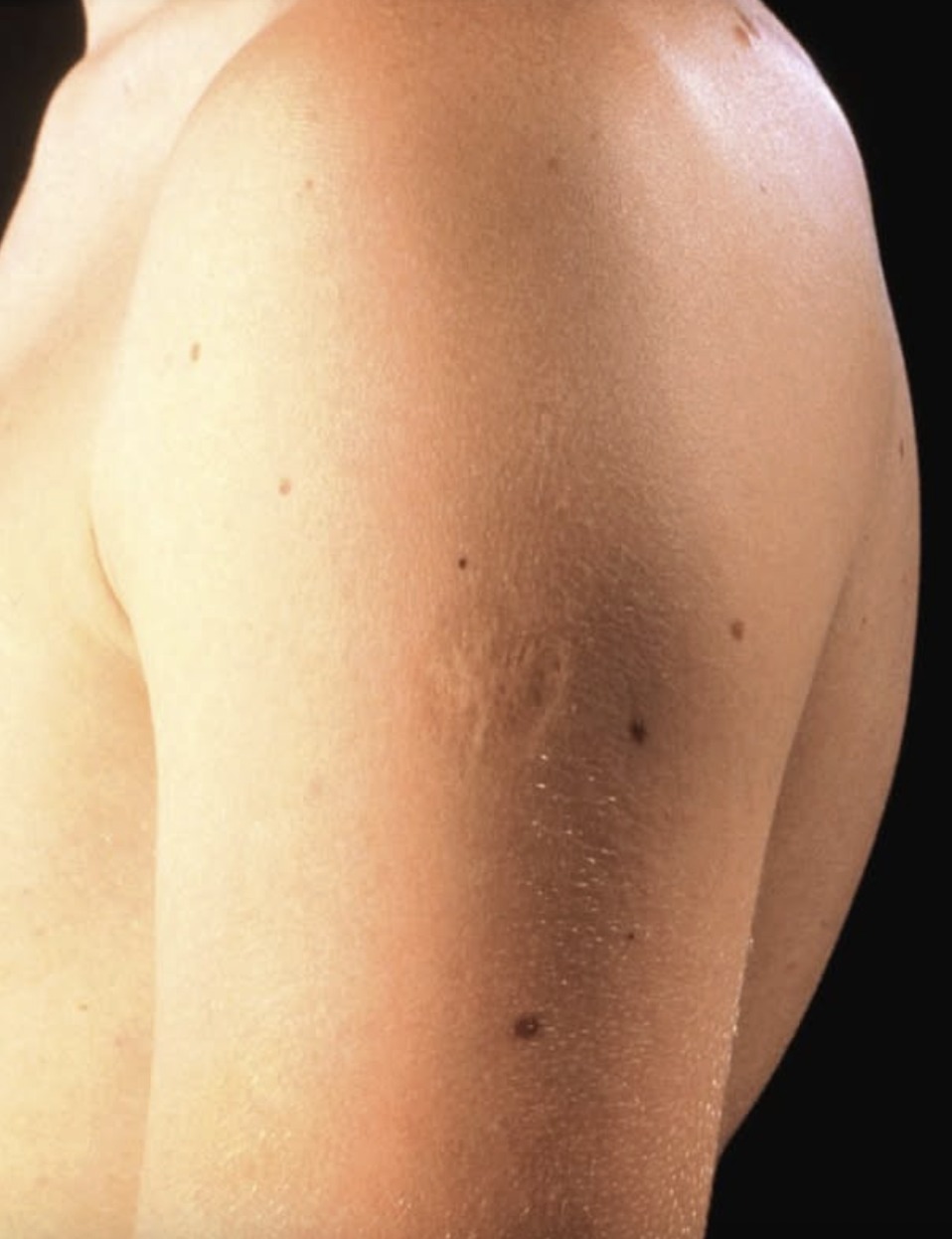 Smallpox vaccine scars! What they look like and why