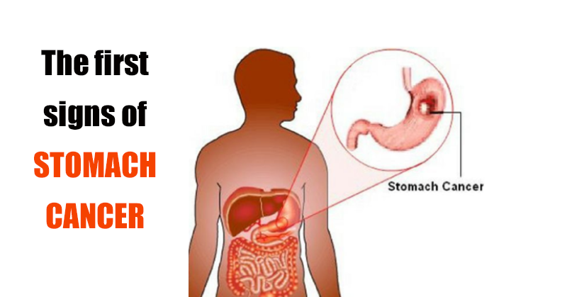 Cancer in the stomach develops silently. These are the first signs! You should be attentive!