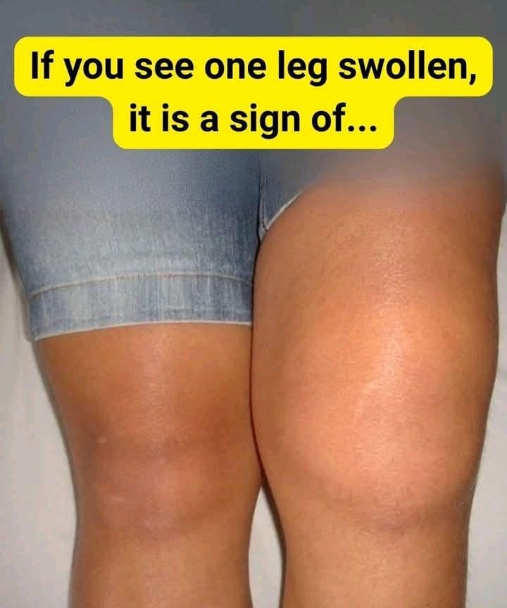 Why Is One Knee Swollen but Not the Other? – Story Of The Day!